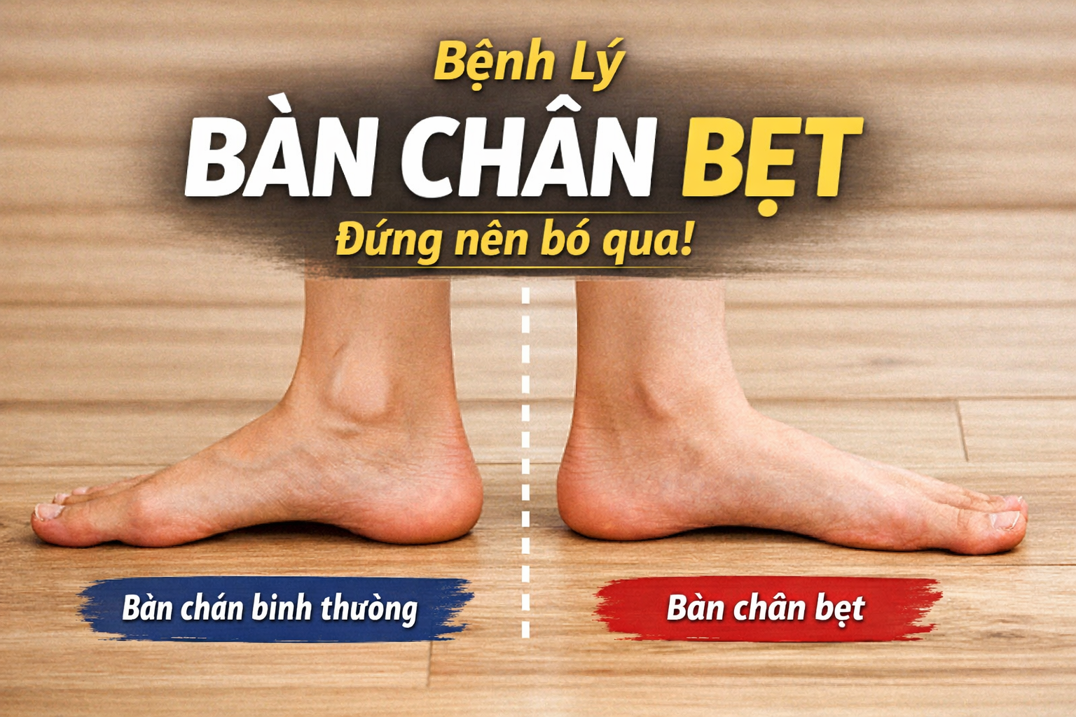 BÀN CHÂN BẸT: DẤU HIỆU NHẬN BIẾT VÀ KHI NÀO CẦN CHÚ Ý?